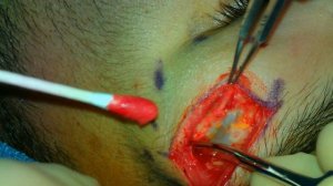 Sub-brow Dermoid Cyst