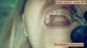 Инфильтрационная анестезия для лечения 23 .Кейс #78.