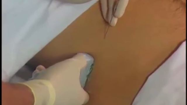 пахового и подвздошно-подчревного нервов под контролем ультразвуковой визуализации смотреть онлайн