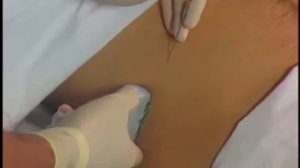 пахового и подвздошно-подчревного нервов под контролем ультразвуковой визуализации