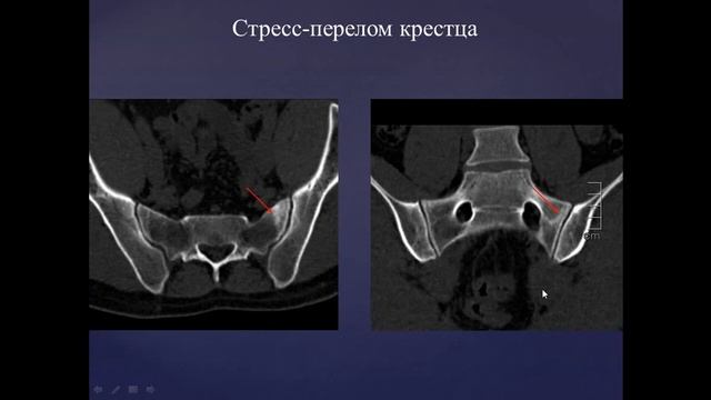 Базовый курс по МРТ  b  Лекция «МР семиотика повреждений тазобедренного сустава»  Лектор  Учеваткин