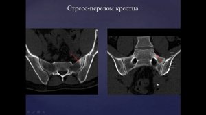 Базовый курс по МРТ b Лекция «МР семиотика повреждений тазобедренного сустава» Лектор Учеваткин