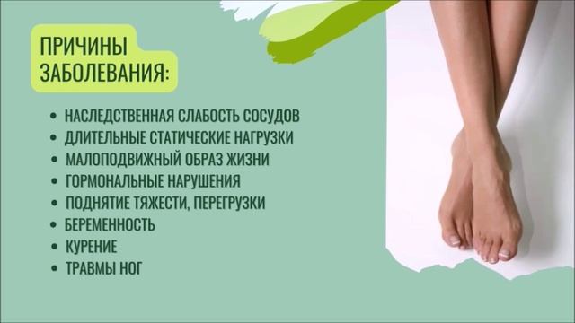Профилактика варикозного расширения вен