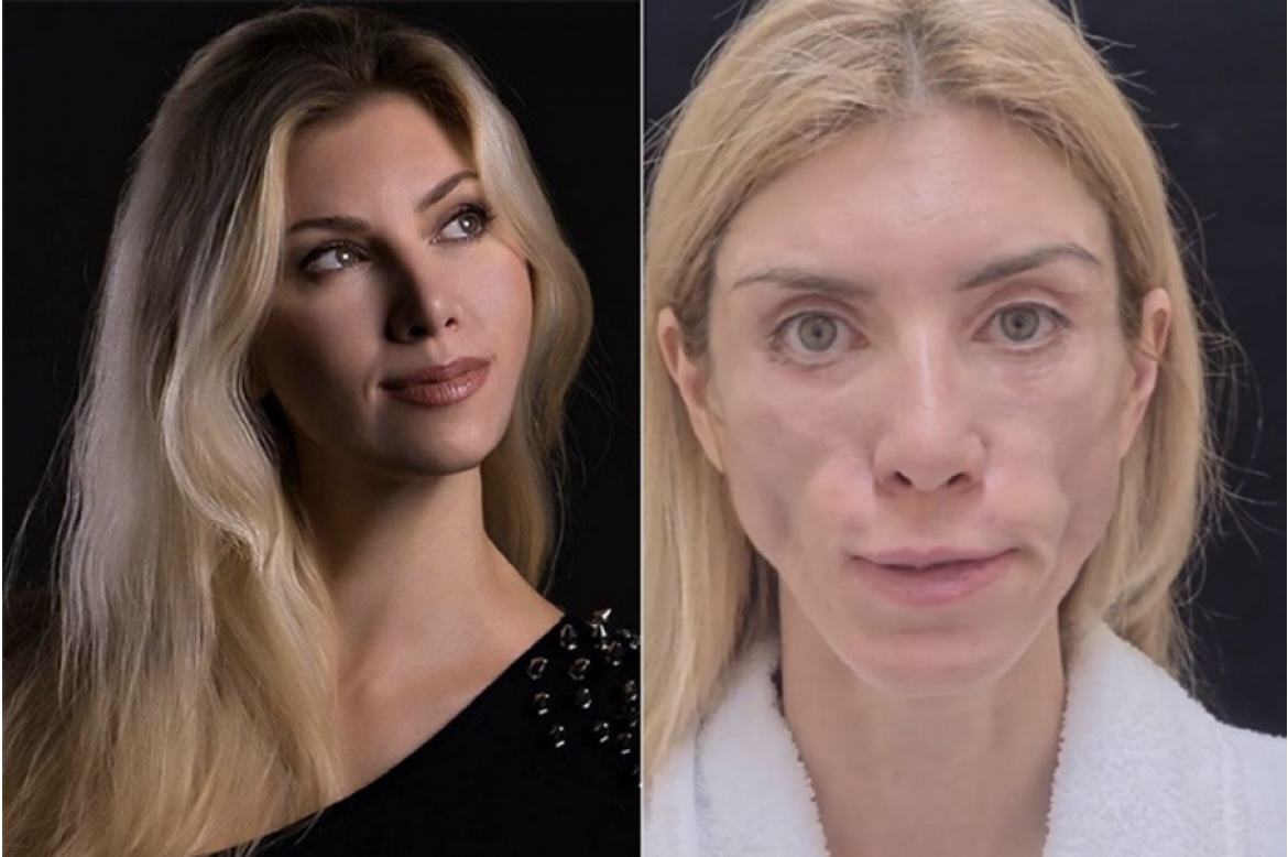 Юлия Тарасевич до и после операции