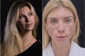 История Юлии Тарасевич. Возвращаем красоту жертве неудачной пластической операции