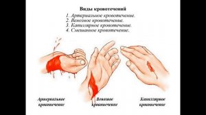 Тема 4. Открытые повреждения, кровотечения: алгоритм оказания первой помощи при ранениях