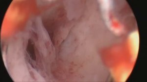 Гистерорезектоскопия