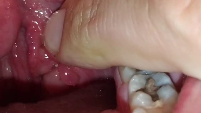 Удаление миндальных камней #8 смотреть онлайн