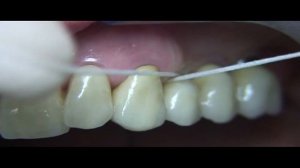 Superfloss impianto