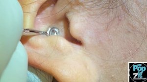 Blackheads in the ear. Ear extractions. Oily plugs extracted. Full face video coming soon. MrPopZit