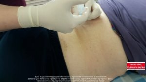 Back Pain Local Injections Лечение БОЛЬ В СПИНЕ после операции 