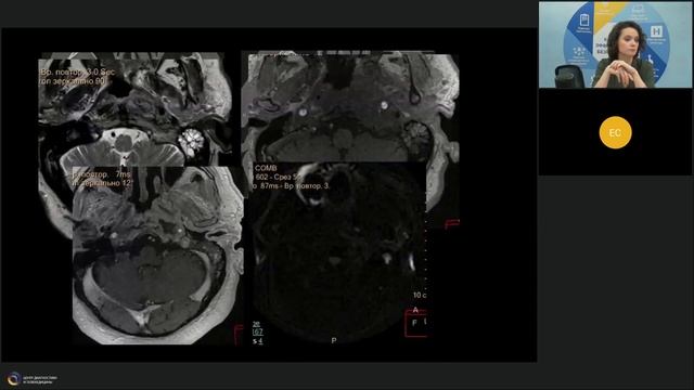 Каудальная группа черепно мозговых нервов: диф. диагноз образований в зоне яремного отверстия смотреть онлайн