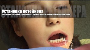 Брекеты!!Мы снимаем БРЕКЕТЫ!!! Как это?! Orthodontic debonding