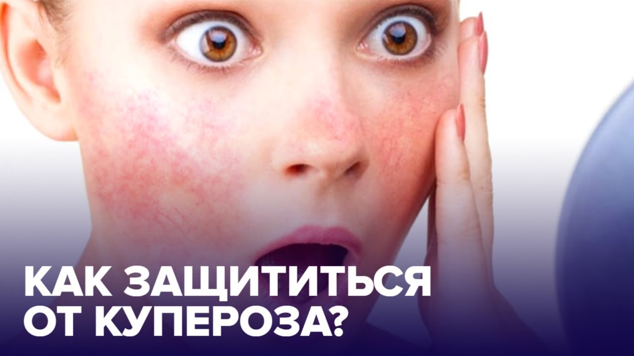 Как предотвратить появление КУПЕРОЗА? Советы дерматолога
