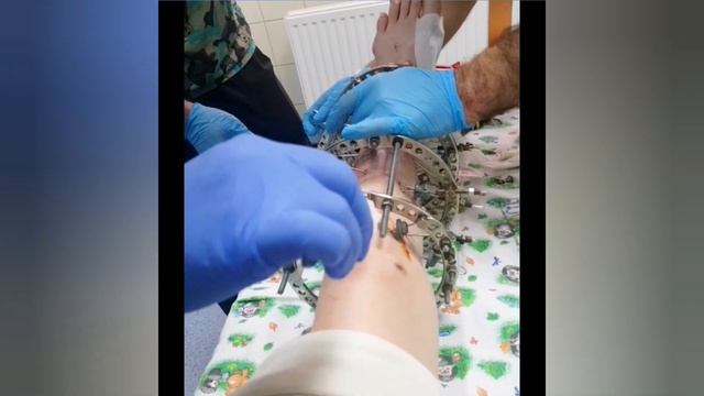 Как снимают спицы аппарата Илизарова со ступни. НА ЖИВУЮ, шок!! смотреть онлайн