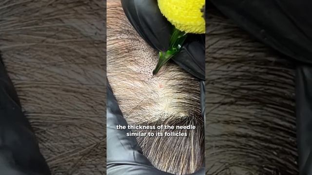 failed hair transplant, hair transplant Turkey, scalp micropigmentation, hair tattoo, head totu