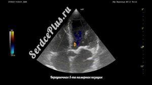 Эхокардиография. Сечения/позиции на ЭхоКГ.