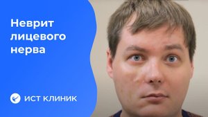 Лечение неврита лицевого нерва. Причины и симптомы пареза.