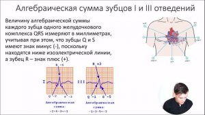 ЭКГ за 100 минут №2: Наложение электродов. Электрическая ось сердца (ЭОС)