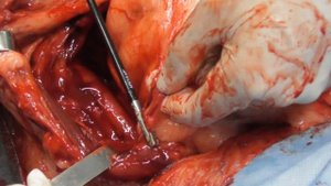 Гигантская межмышечная липома области шеи у собаки