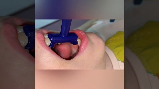 Зондозаменители с бусиной