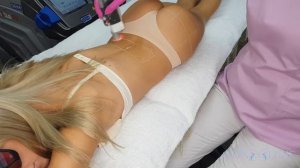 Лазерная эпиляция спины