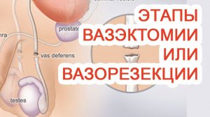 Этапы вазэктомии / вазорезекции / Доктор Черепанов