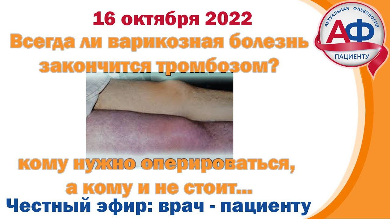Варикозные вены - всегда ли будет тромбоз? И врачам и пациентам смотреть онлайн