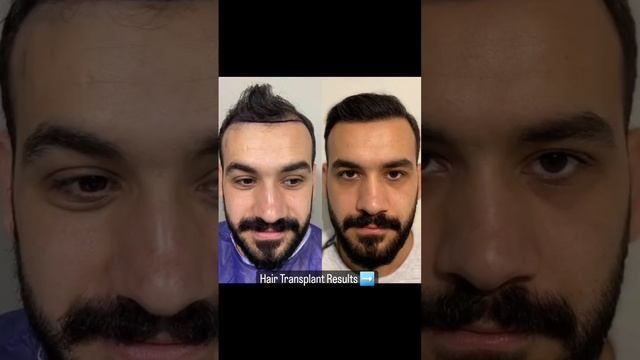 Hair Transplant in Turkey Results | Пересадка волос в Турции Результаты смотреть онлайн