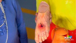 Что делать, если вы поранились? Жить здорово! Фрагмент выпуска от 04.05.2017