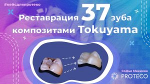 Реставрация 37 зуба | лечение глубокого кариеса #зубы #стоматология  #кариес