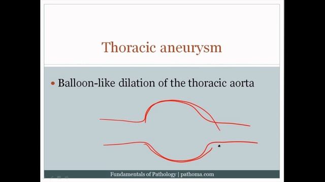 Pathoma USMLE - VII ГЛАВА - 4.Расслоение аорты, аневризмы