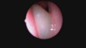 010 полипы в носу