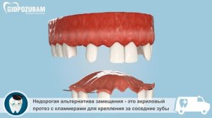 Съемные зубные протезы: частичный акриловый протез