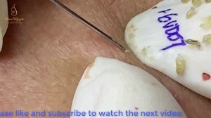 ACNE REMOVAL to have glowing skin care (91) |Loan Nguyen