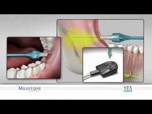 Мандибулярная анестезия