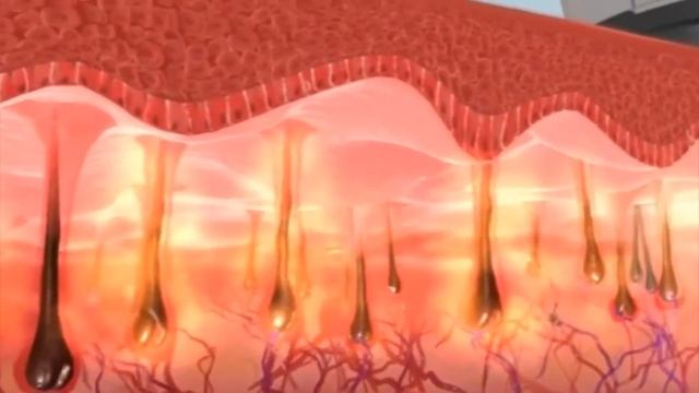 О Лазерной эпиляции смотреть онлайн
