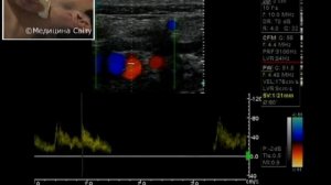 Полная методика УЗИ сонных и позвоночных артерий