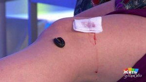 Гирудотерапия (лечение пиявками). Жить здорово! Фрагмент выпуска от 30.01.2018