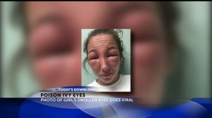 Girl gets poison ivy on eyes