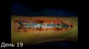 Выжигание татуировки йодом. 3 неделя.