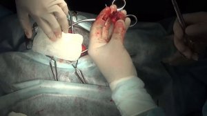 Резекционная артропластика ТБС