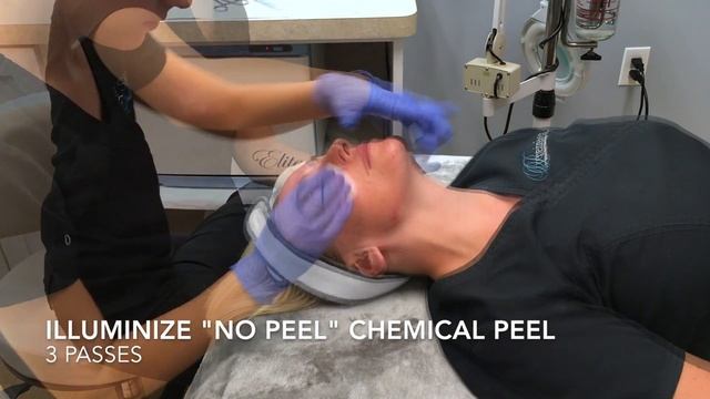 DermaPeel смотреть онлайн