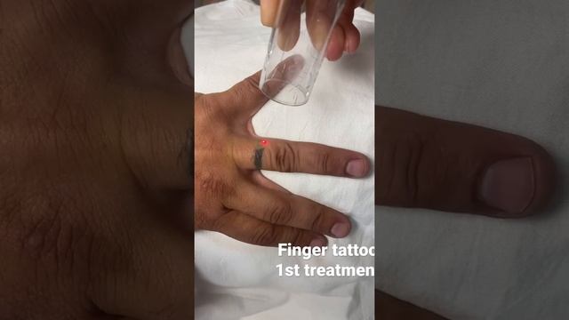 Removing a wedding band tattoo at ExcelLase , fast and effective