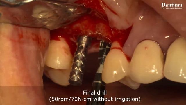 Hydraulic sinus lift technique using DASK Dentium sinus kit смотреть онлайн
