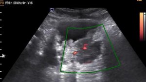 Объемное образование мочевого пузыря ЦДК