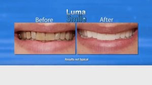 Прибор для очистки зубов Luma Smile