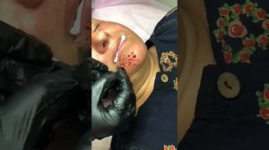 Провела капилляротерапия лица