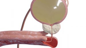 Процесс мочеиспускания при заболеваниях предстательной железы