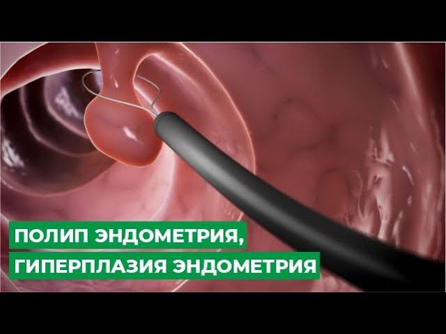 Полип эндометрия, гиперплазия эндометрия
